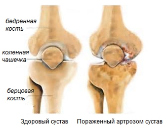 Здоровый и пораженный артрозом коленный сустав