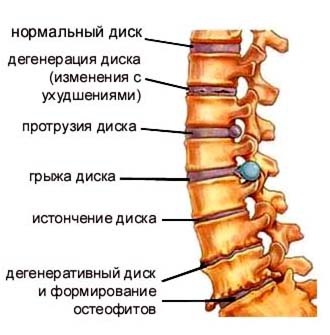 Лечение болей при грыжах в Санкт-Петербурге - клиника Longa Vita