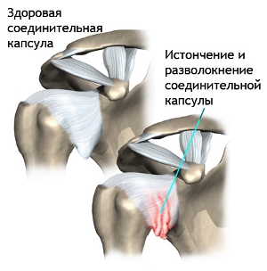 Причины и механизм развития плечевого артрита